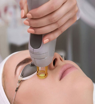 LASER FACIAL